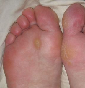 Foot callus