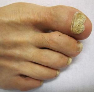 Fungal toe nails