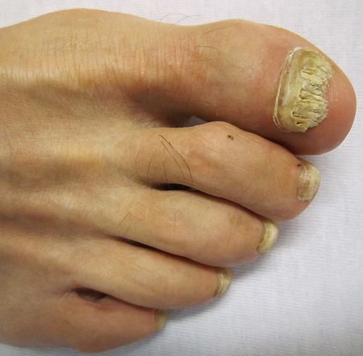 Fungal nail infection in care home